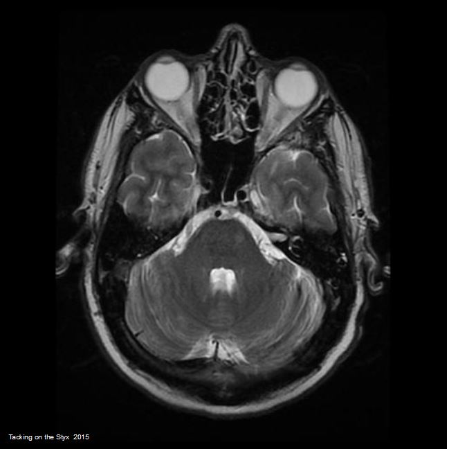 optic nerves, anterior temporal lobes, dorsal surface cerebellum, transverse plane