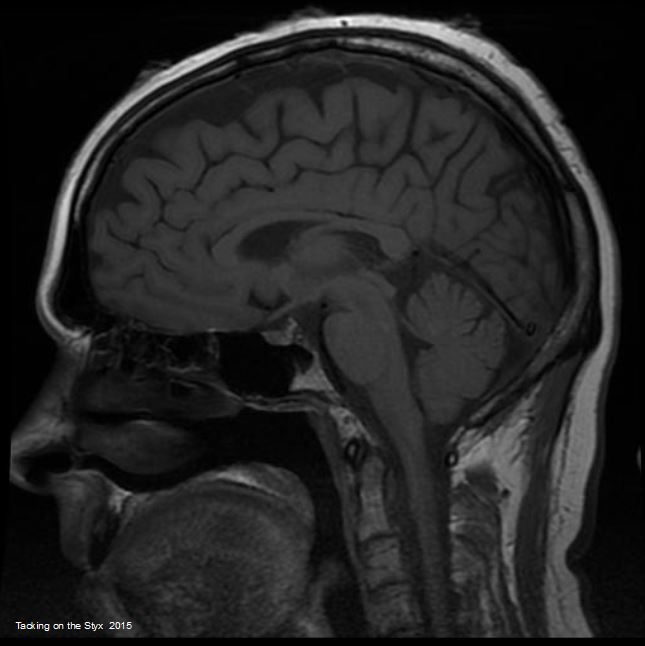 A sagittal plane view of the cerebrum, the cerebellum, and the brainstem in an MRI. 