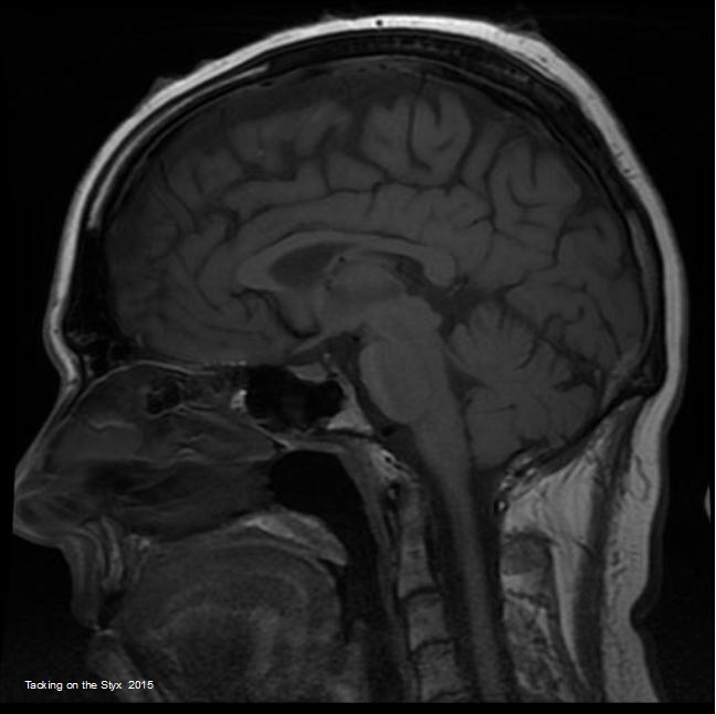 Saggital plane  showing frontal, parietal and occipital  lobes, pons