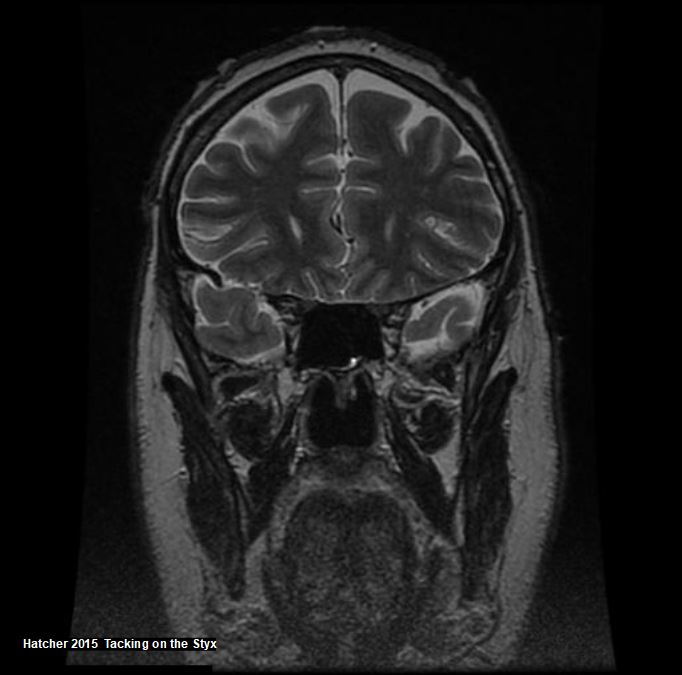 Coronal brain MRI showing superior sagittal sinus, sylvian fissure.