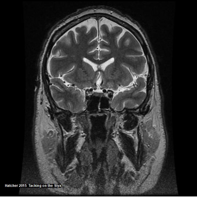 Coronal brain MRI showing internal carotid arteries, parotid gland, nasopharynx, mandibular division. 
