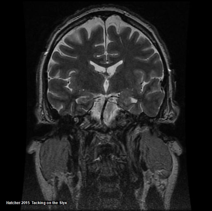 Coronal brain MRI showing auditory canal and cochlea. 
third cranial nerve