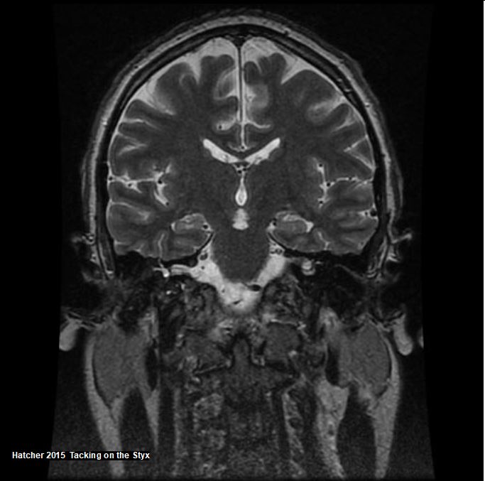 Coronal brain MRI showing hippocampus, interpeduncular cistern, inner ear, pons, corpus callosum, superior sagittal sinus, preganglionic segment, third cranial nerve.  