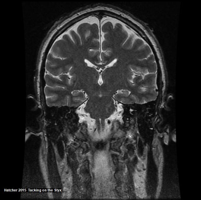 Coronal brain MRI showing hippocampus, pons, thalamus, ambiens cistern, parahippocampal gyrus, temporal pole, cerebral peduncle.  