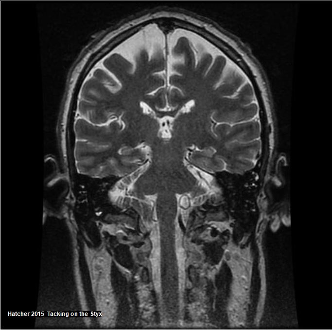 Coronal MRI shows the cerebellar peduncle, spinal cord, fornix, cerebral peduncle, medulla oblongata, brain stem, tentorium cerebelli. Jeffrey Hatcher