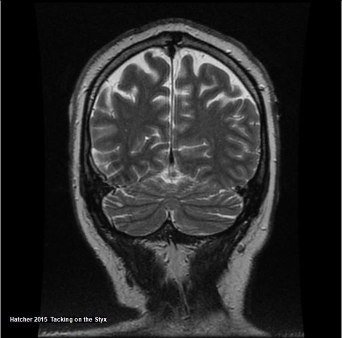 Coronal brain MRI showing intraparietal sulcus, precuneus, straight sinus.