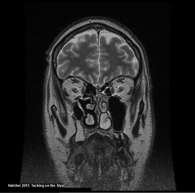 Coronal brain MRI showing frontal gyrus, orbital gyrus, optic nerve, ethmoid sinus, maxillary antrum, turbinate bones. 