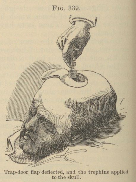 Trephining a patient - a form of brain surgery in the nineteenth century.