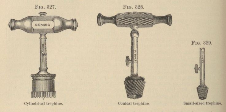 Trephination or trephining was sometimes used to treat epilepsy. Tools shown from The Principles and Practice of Surgery, 1889