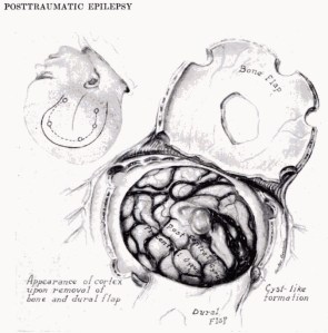 military manual diagram for brain surgery to stop epilepsy