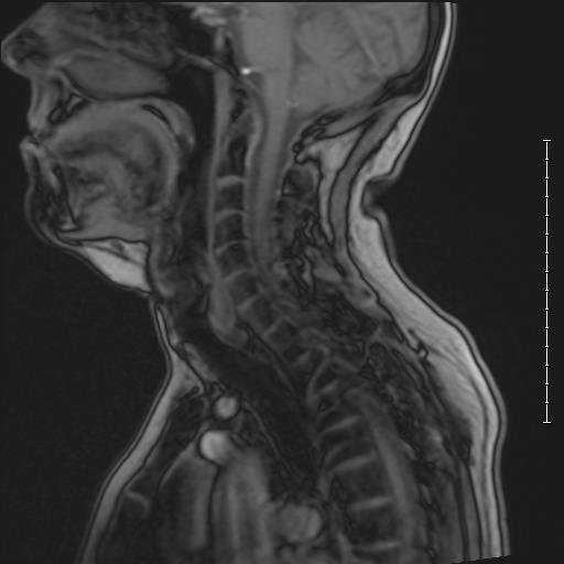 Sagittal view of cervical vertebrae from adult male with mild scoliosis. Image is an MRI and also shows the pons,  cerebellum, and trapezius muscle.