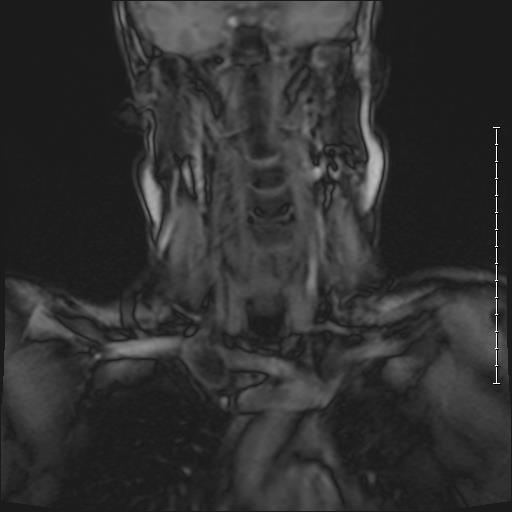 Cervical part of spine showing scoliosis