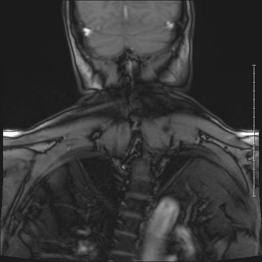 A view of a mans spine with mild scoliosis.