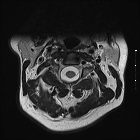 cervical MRI clearly showing arteries and veins of neck