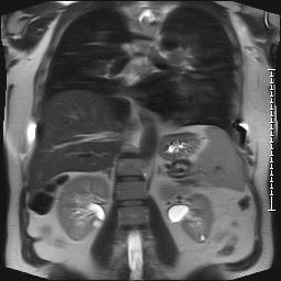 MRI frontal view of human thoracic cavity showing liver and kidneys