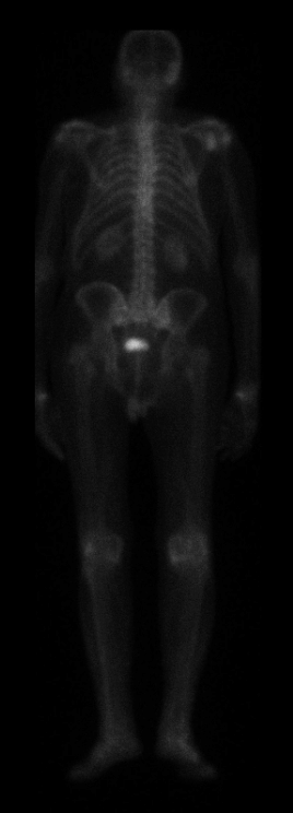 bone density scan of whole skeleton elderly man